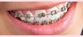 Behel Platinum