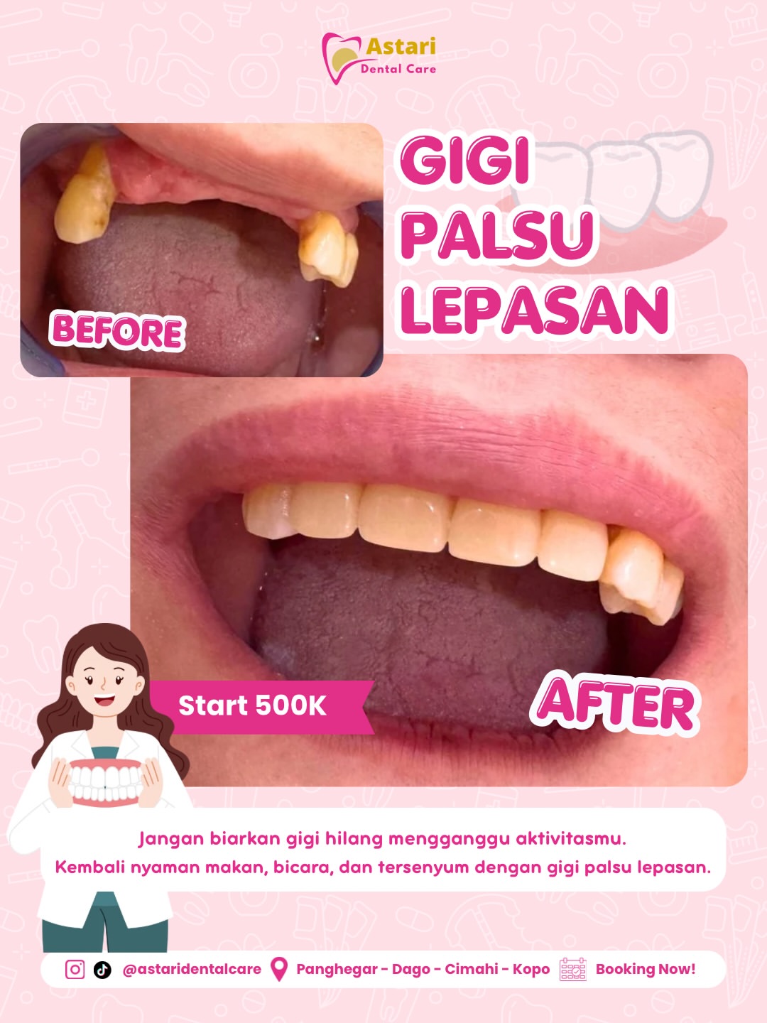 Gigi Palsu Lepasan