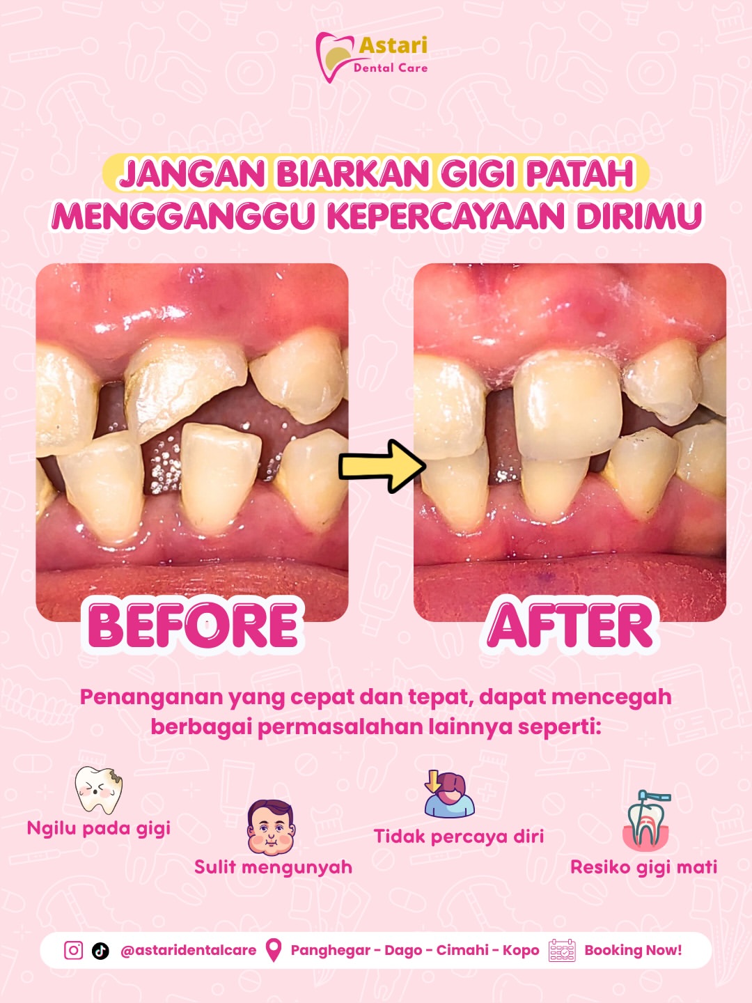 Perbaikan Gigi Patah